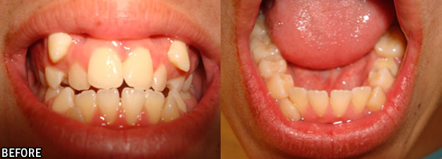 Orthodontia Before