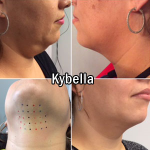 Kybella antes y después