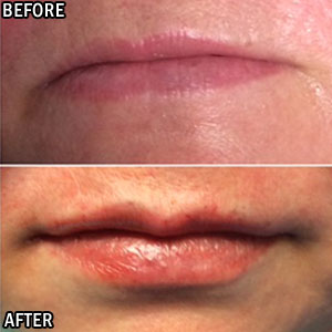 Aumento de labios antes y después