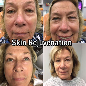 Rejuvenecimiento de la piel antes y después