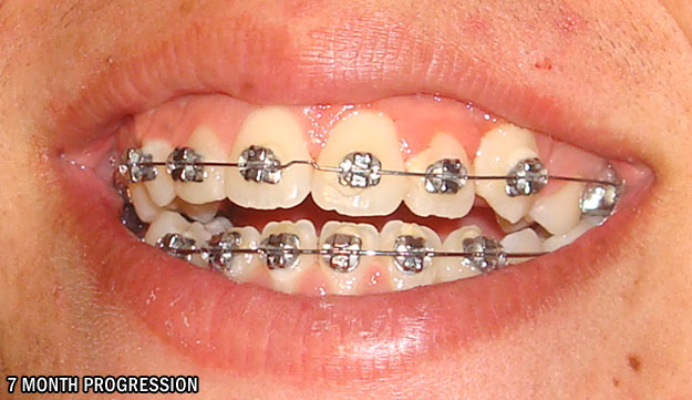 Orthodontia progression after 7 months