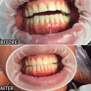 Cosmetic dentistry Before and After