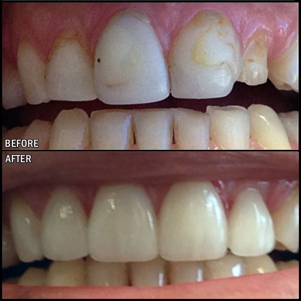 Crowns Before & After