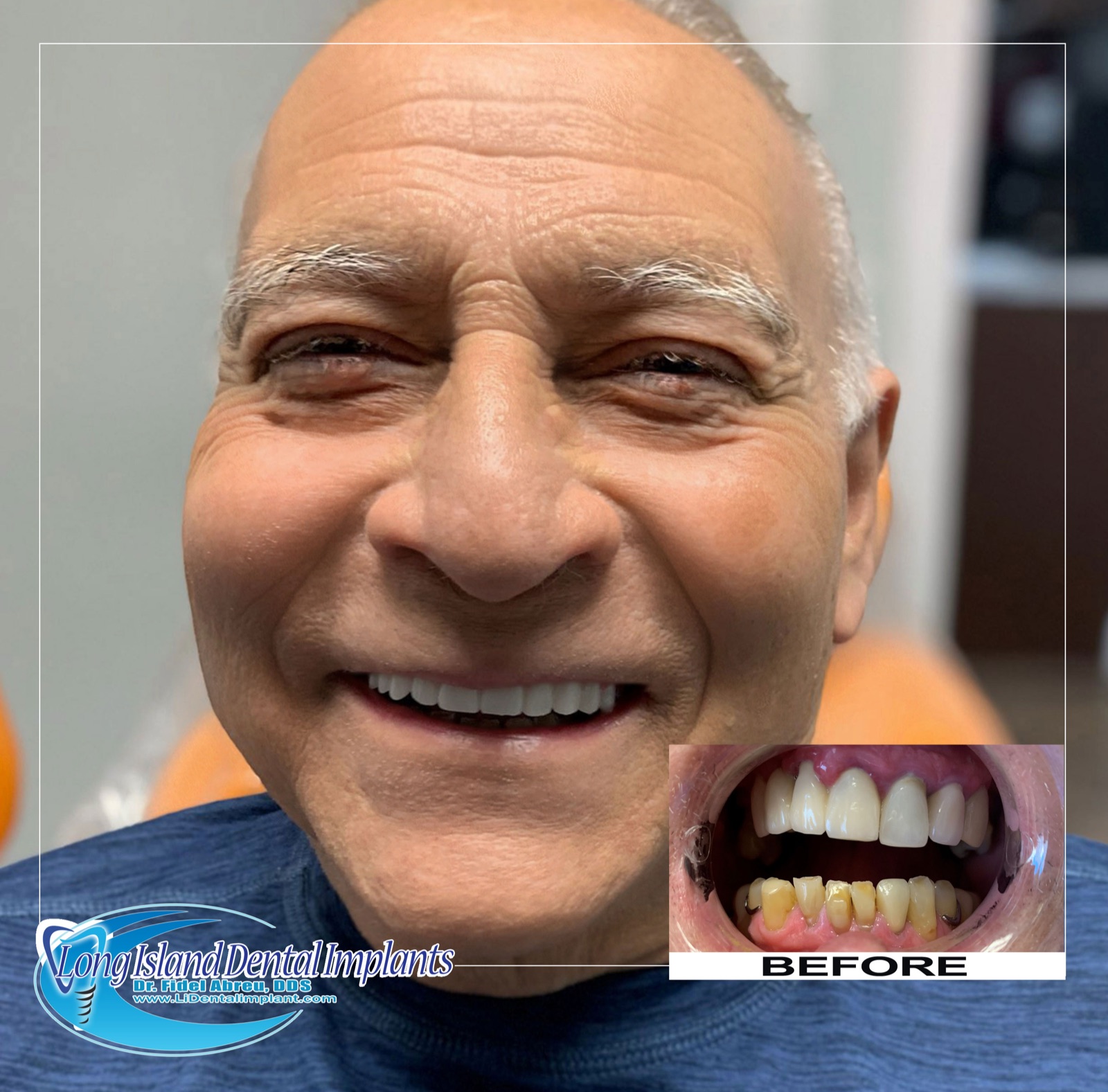 Before and after — implant patient Carlos, Freeport NY